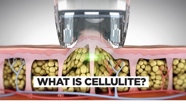 What is cellulite?